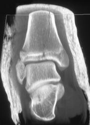 Tibial Fracture - CTisus CT Scan