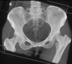 Femur Fracture - CTisus CT Scan