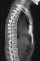 Failed Pectus Repair - CTisus CT Scan