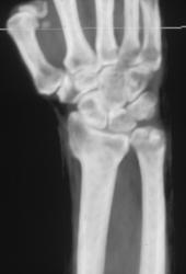 Subtle Radial Fracture - CTisus CT Scan