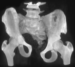 Post Pelvic Reconstructive Surgery - CTisus CT Scan