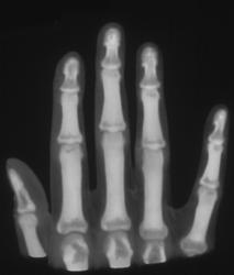 Hands Up and Be Counted - CTisus CT Scan