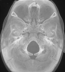 Normal Skull Base - CTisus CT Scan