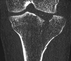 Tibial Plateau Fracture - CTisus CT Scan