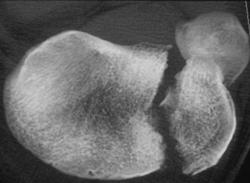 Tibial Plateau Fracture - CTisus CT Scan