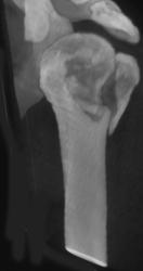 Humeral Fracture - CTisus CT Scan