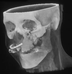 Facial Fractures - CTisus CT Scan