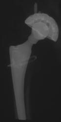 3D of Total Hip Replacement (THR) on Left - CTisus CT Scan