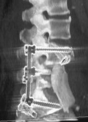 Post Spiral Fusion - CTisus CT Scan