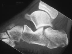 Calcaneal Fracture - CTisus CT Scan