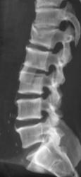 Spinal Fusion - CTisus CT Scan