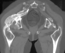 Myositis Ossifications With Fusion - CTisus CT Scan