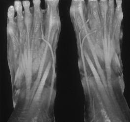 Normal Tendons - CTisus CT Scan