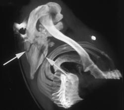 Scapular Fracture - CTisus CT Scan