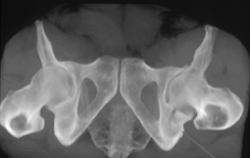 Acetabular Fracture - CTisus CT Scan