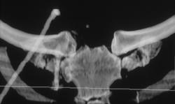 Osteomyelitis (rt S/c Joint) - CTisus CT Scan