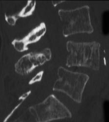 Step Off of L4-l5 in 3D - CTisus CT Scan