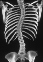 Scoliosis - CTisus CT Scan