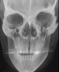 Cleft Palate - CTisus CT Scan