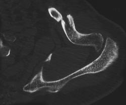 Clavicle Fracture - CTisus CT Scan