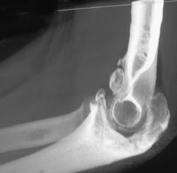 Osteoarthritis Elbow - CTisus CT Scan