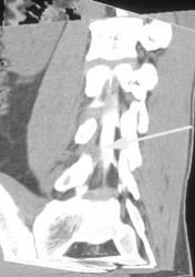 Post-op Scarring - CTisus CT Scan