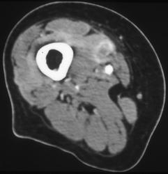 Abscess - CTisus CT Scan