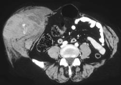 Hematoma With Active Bleed - CTisus CT Scan