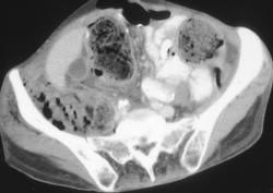 Sacroiliitis - CTisus CT Scan