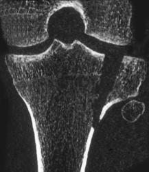 Tibial Plateau Fracture - CTisus CT Scan