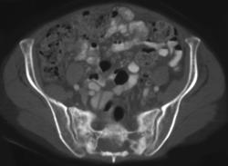 Stress Fracture of Sacrum - CTisus CT Scan