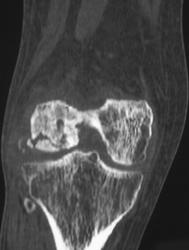 Avascular Necrosis - CTisus CT Scan