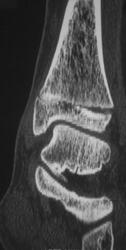 Salter IV Fracture - CTisus CT Scan