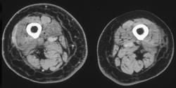 Myositis - CTisus CT Scan