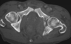 Lymphoma of Lt Iliac Bone - CTisus CT Scan