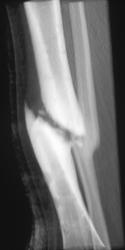 Non-union Tibia - CTisus CT Scan