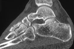 Normal Ankle With MDCT - CTisus CT Scan