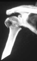 Humerus Fracture - CTisus CT Scan