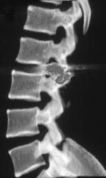 Gun Shot to Spine - CTisus CT Scan