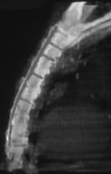 Nice Metal Rods in Sternum - CTisus CT Scan