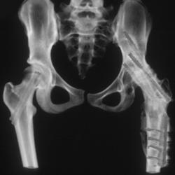 Fused Hip Joint - CTisus CT Scan