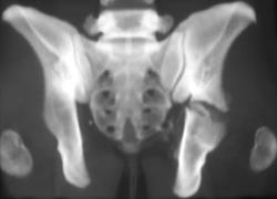 Acetabular Fracture - CTisus CT Scan