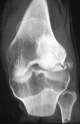 Avascular Necrosis (AVN) With Subchondral Fracture - CTisus CT Scan