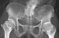 Dysplastic Hips - CTisus CT Scan