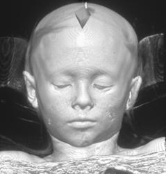 3D Face With Shading - CTisus CT Scan