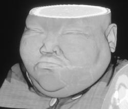 3D Imaging of the Face - CTisus CT Scan