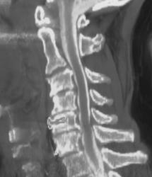 Degenerative Joint Disease (DJD) on CT Myelogram. Prior Surgery at CS-6 Noted. - CTisus CT Scan