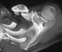 Non-union Clavicle Fracture - CTisus CT Scan