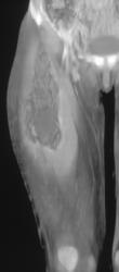 Thigh Abscess - CTisus CT Scan