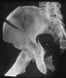 Iliac Wing Fracture - CTisus CT Scan